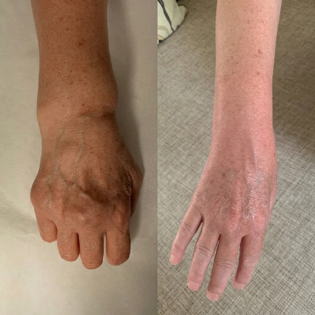 LedBalsam™ - Naturlig formel til ømme knæ, skuldre og hænder.